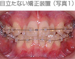 歯周病
