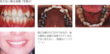写真1 目立たない矯正装置、写真2 見えない矯正装置