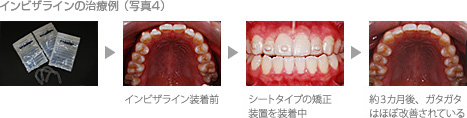 写真4 インビザラインの治療例