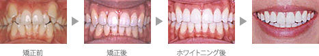 矯正とホワイトニング