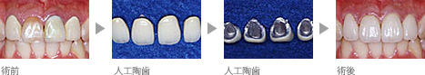 PFMクラウンの例