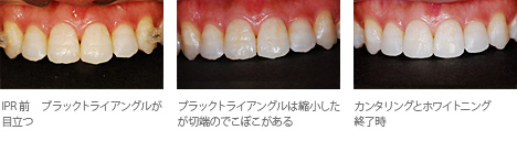 トリミング(IPR)&カンタリング