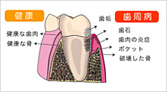 歯周病
