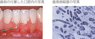 歯垢の付着した口腔内の写真、歯周病細菌の写真